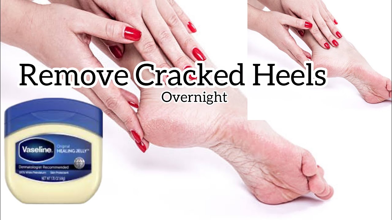 Remove Cracked Heels Overnight | یہ ویزلین پھٹی ایڑیوں کو بناۓ خوبصورت | Get Soft & Beautiful Heels
