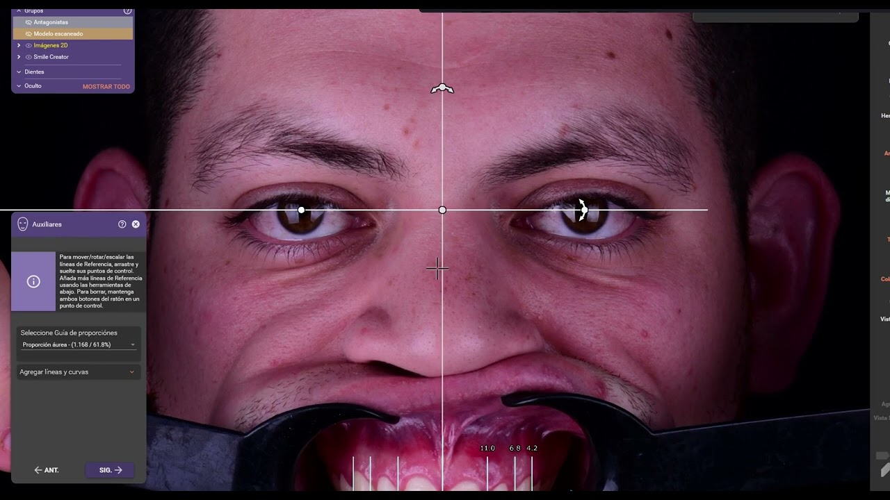 Diseño de sonrisa en Exocad