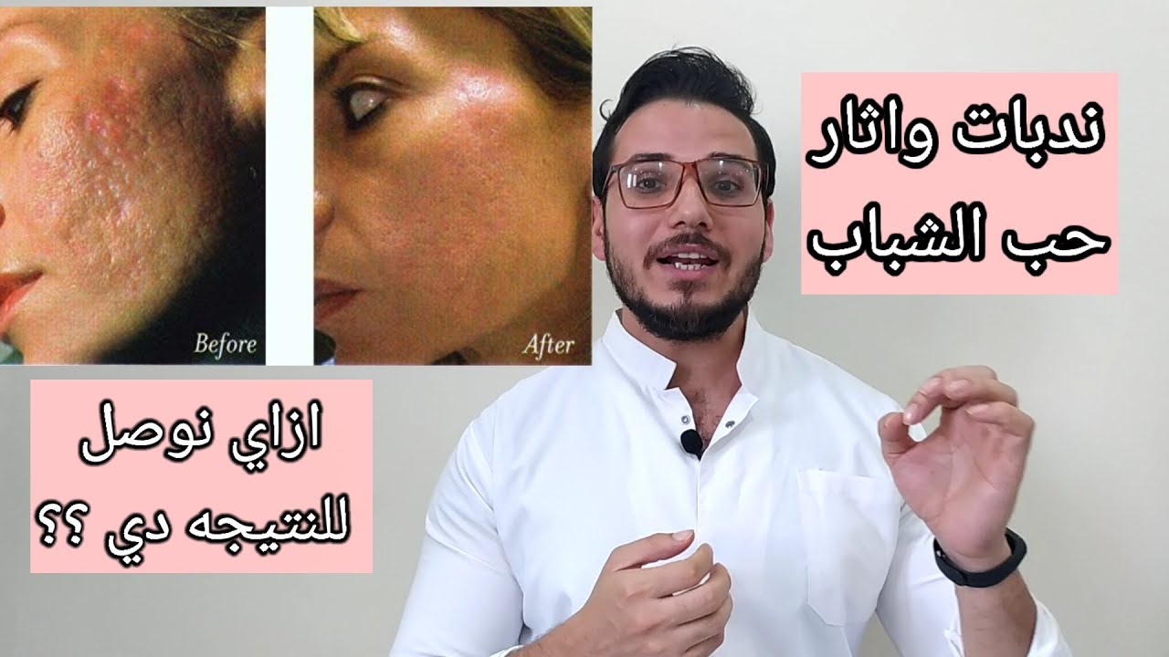 ايه الجديد في علاج ندبات واثار حب الشباب ؟  ازاي بنعالجها تماما ؟وايه انواعها  ؟وبتاخد وقت اد ايه؟