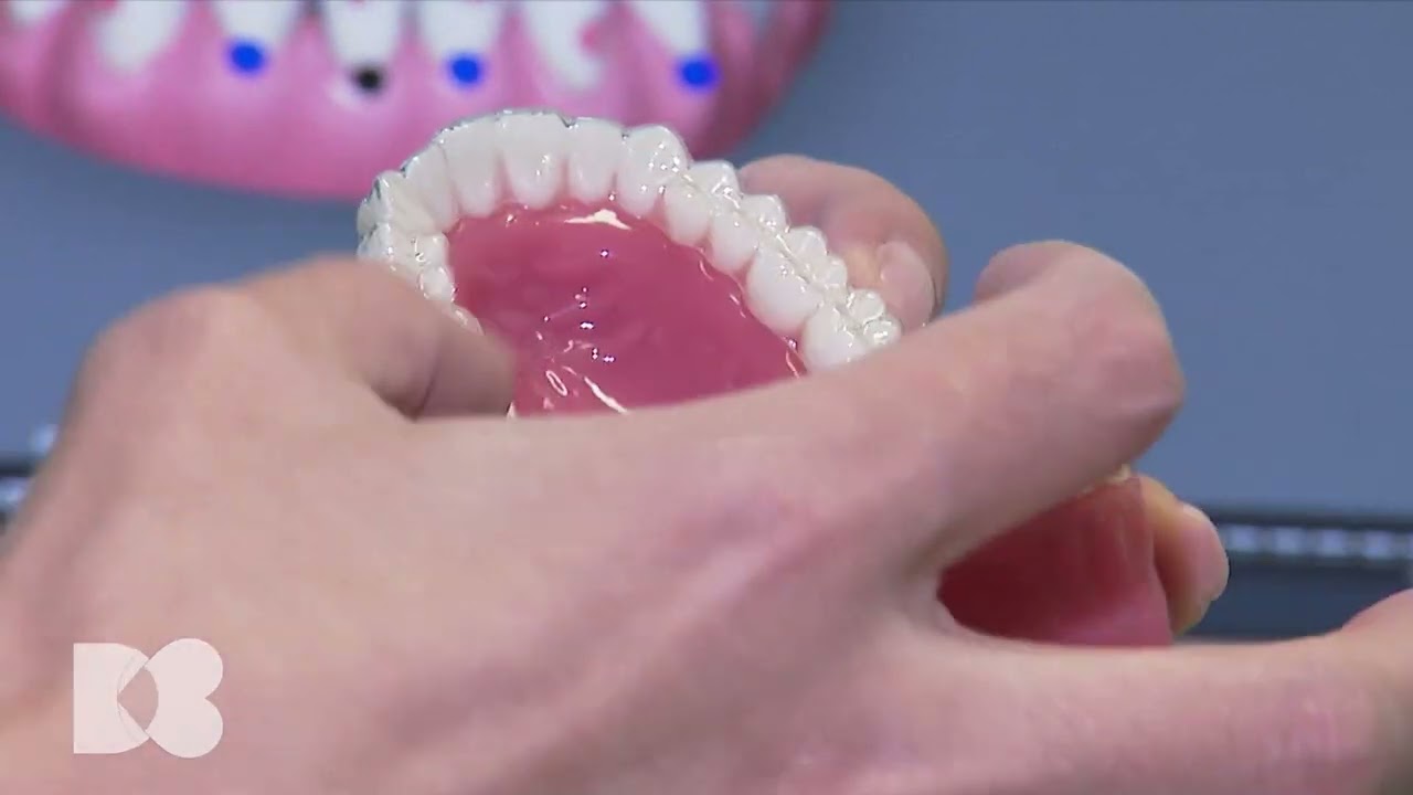 Gutiera, inlocuitorul estetic al aparatului dentar