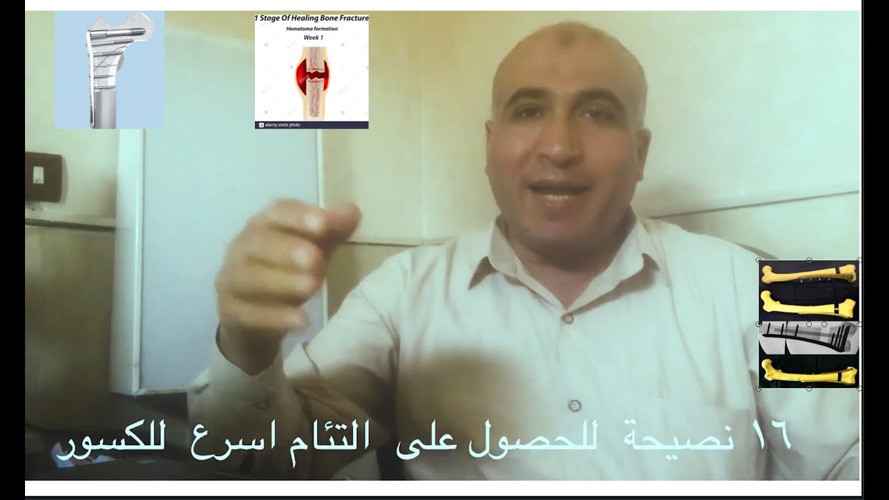 نصائح التئام الكسور والعظام