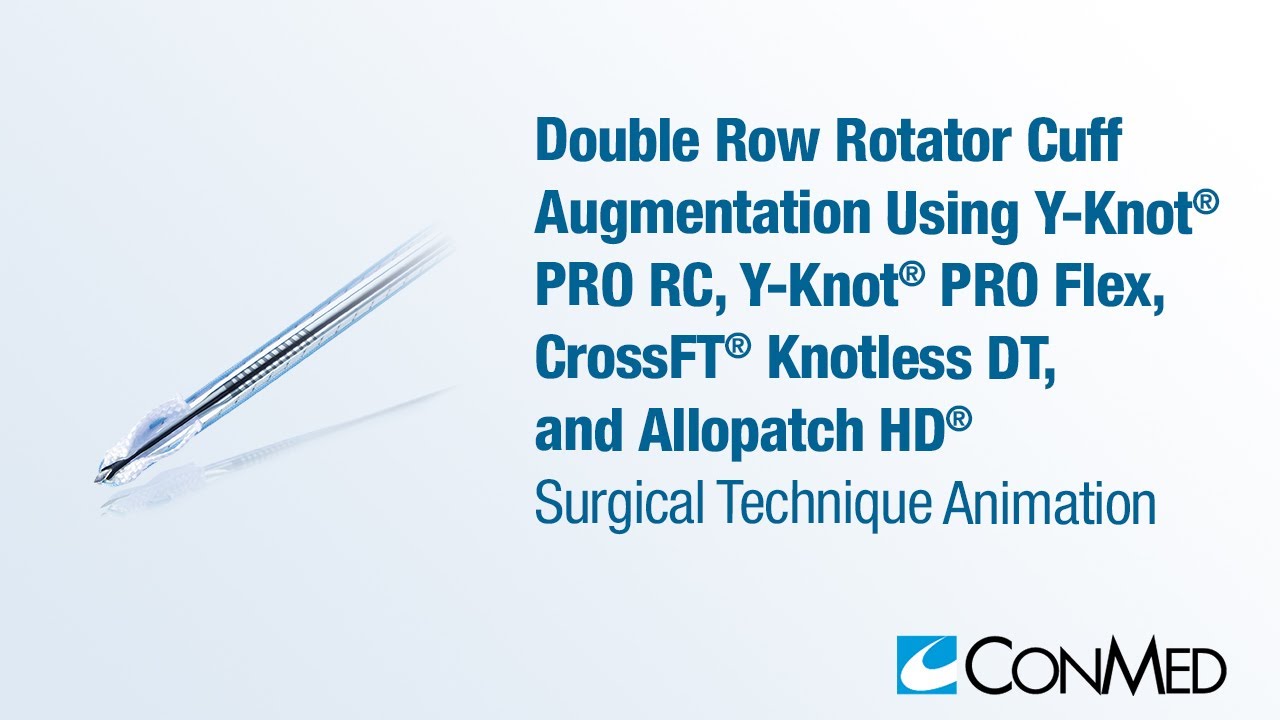 Double Row Cuff Augmentation Using Y-Knot® PRO RC and Flex, CrossFT® Knotless DT, and Allopatch HD®