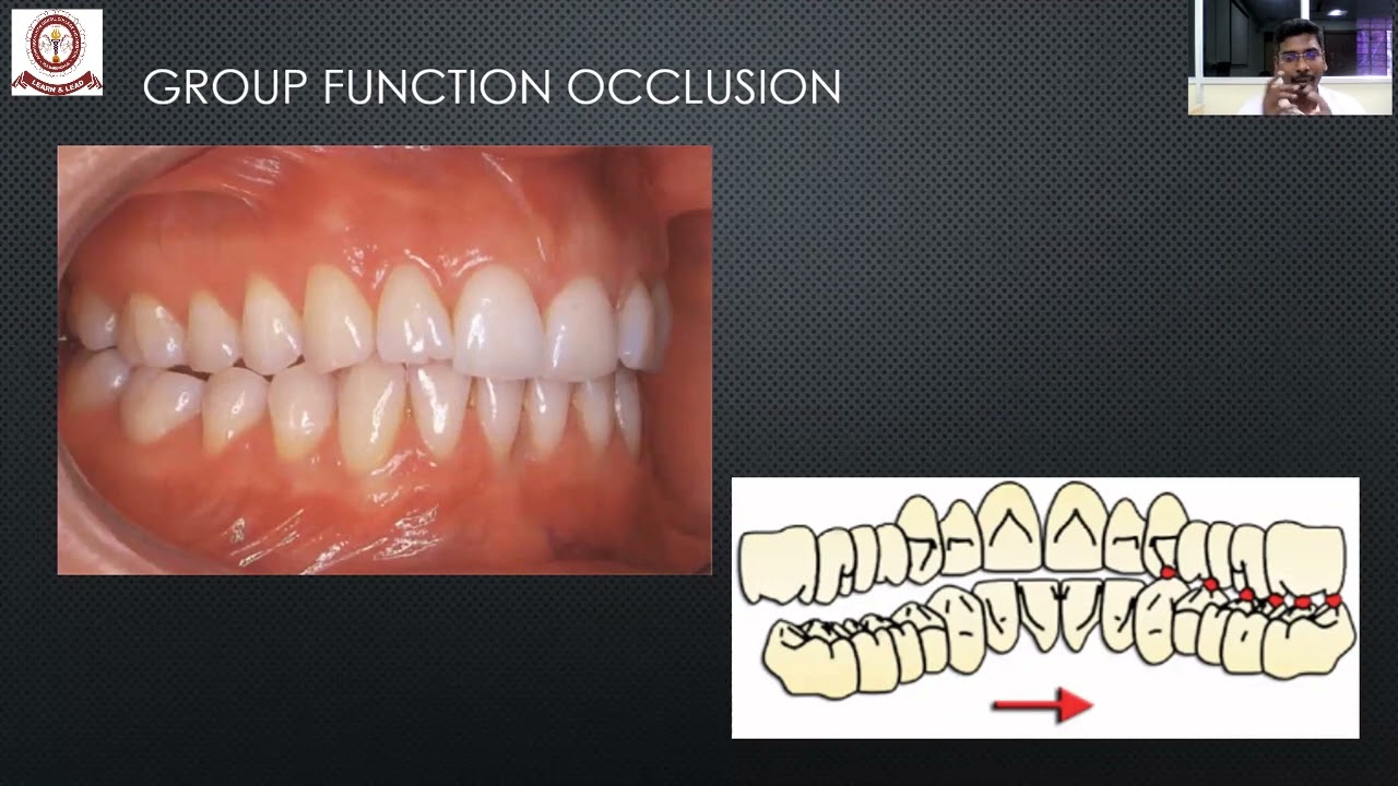 Occlusion In Complete Denture