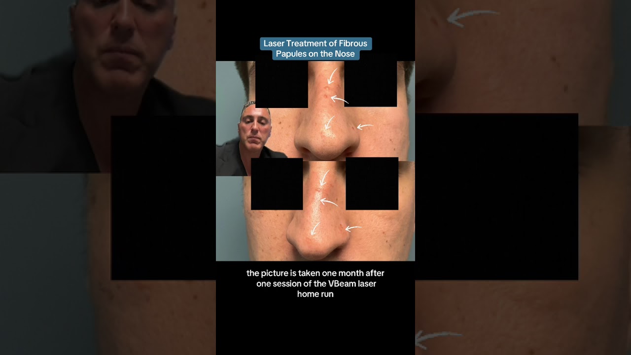 Laser Treatment of Fibrous Papules on the Nose