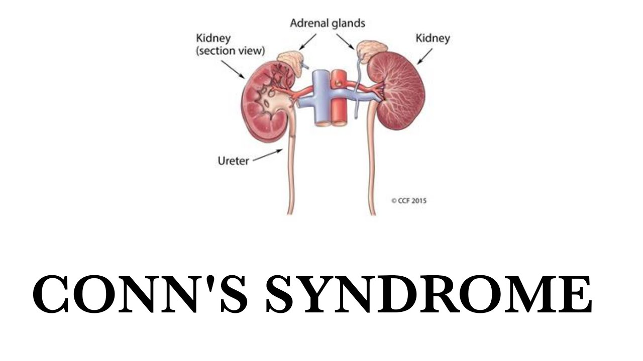 Conns syndrome || Hyperaldosteronism