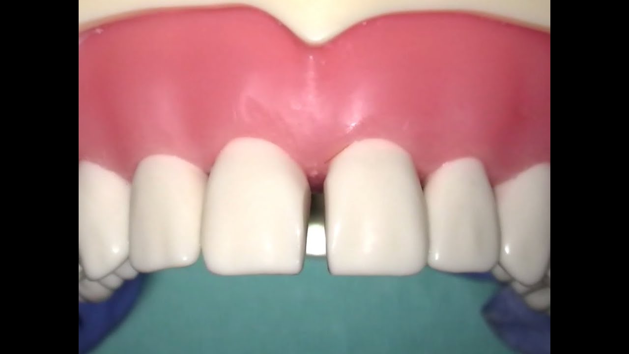 Diastema Closure