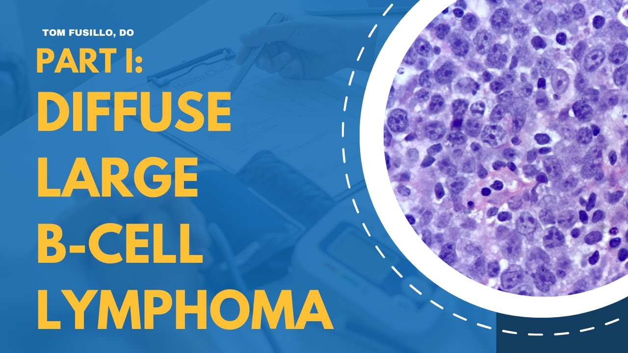 Diffuse Large B-Cell Lymphoma | Part I: Epidemiology, Genetics, Subtypes, Workup, and Pathology