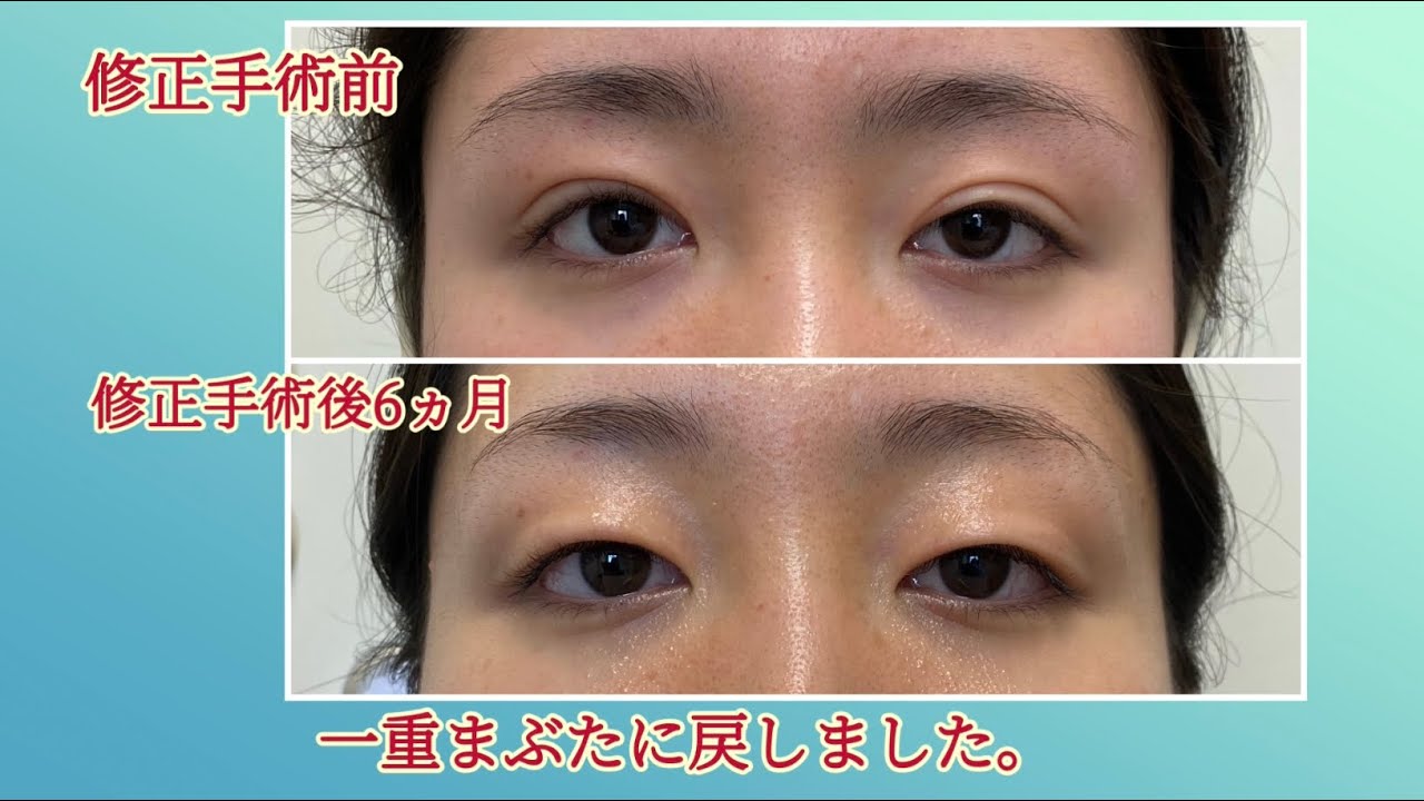 一重まぶたに戻しました。二重まぶたライン幅を狭くする。2022.09.27
