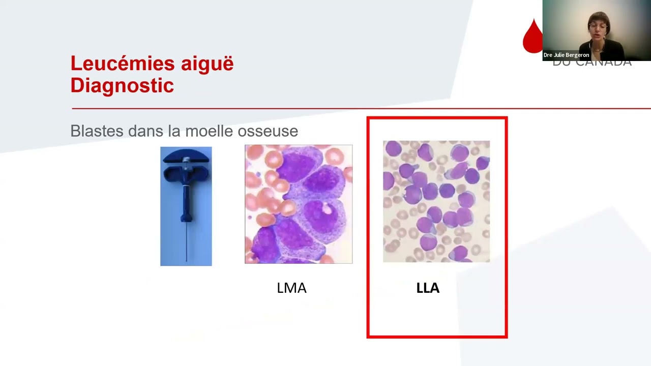 Comprendre la leucémie lymphoblastique aigue (LLA): La conférence sur la leucémie 2024