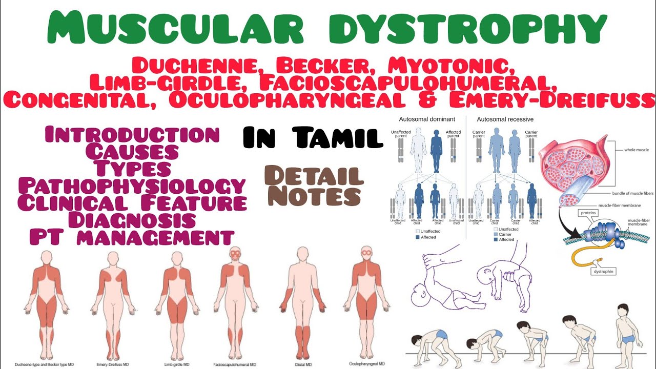 Muscular dystrophy - intro, types, c/f, diagnosis and PT management #tamil #notes #physiotherapy 