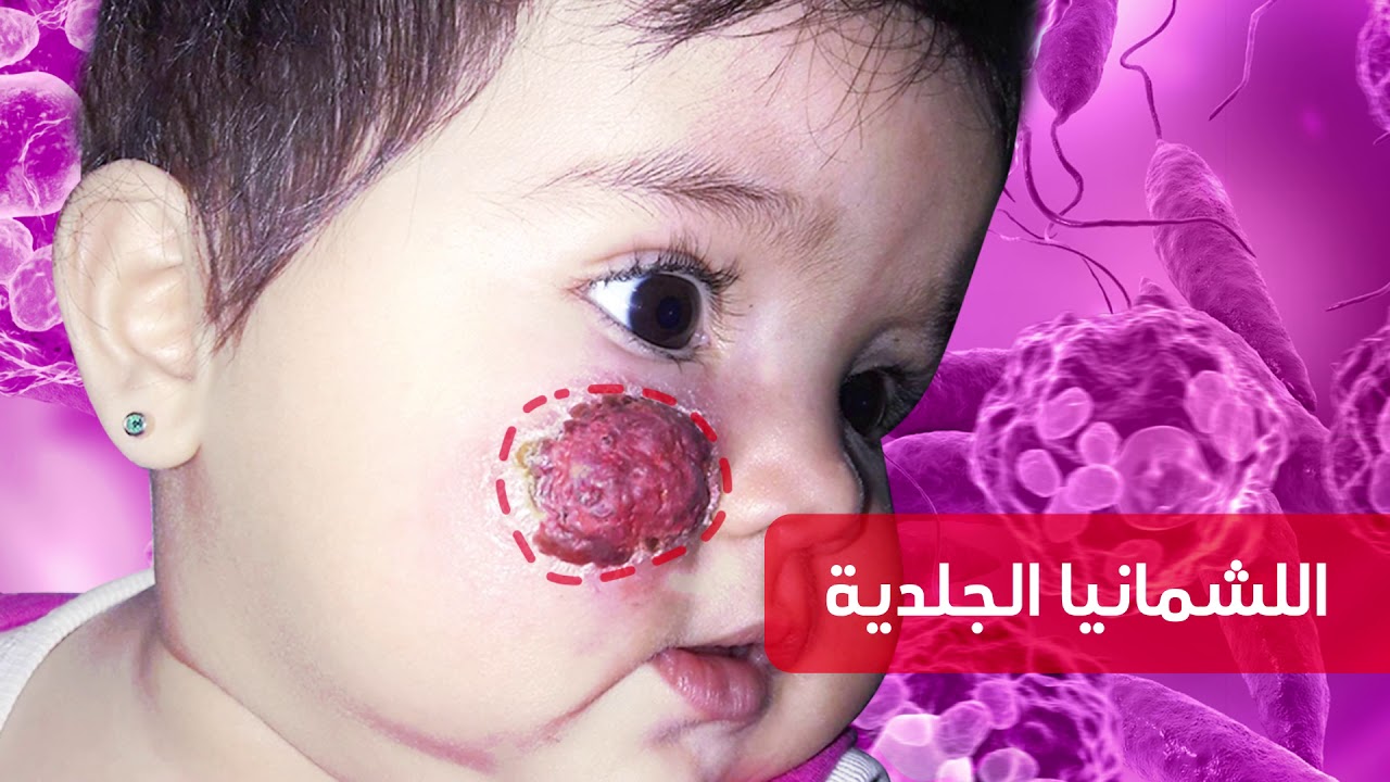 مرض اللشمانيا.. أسبابه وأعراضه.. وسبل الوقاية منه