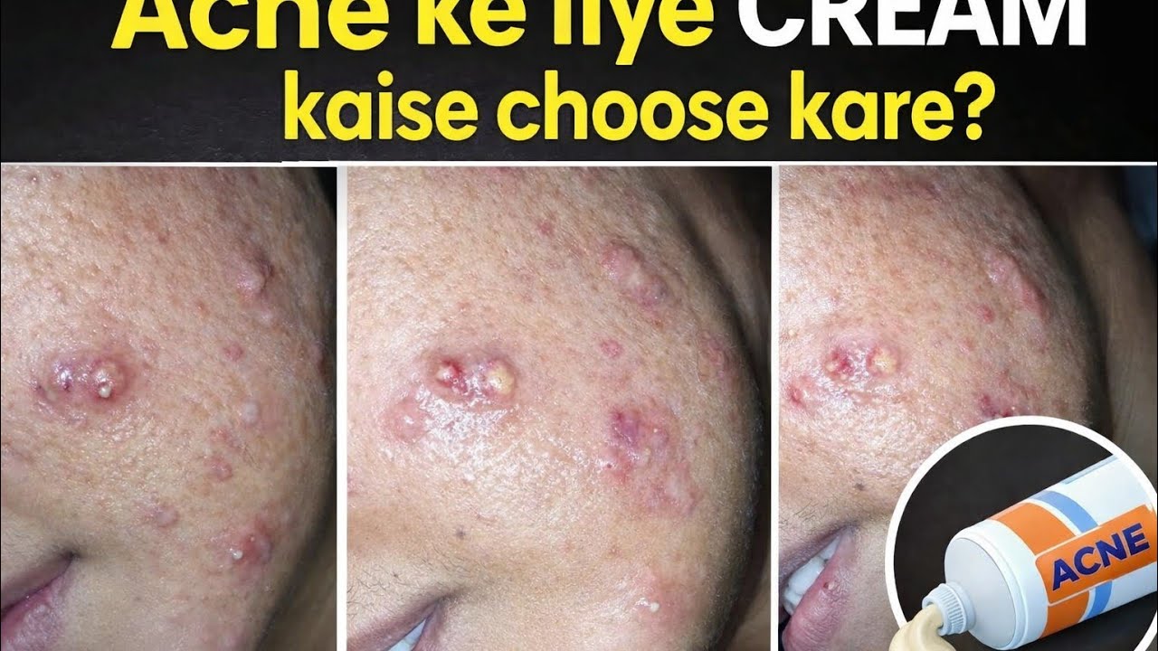 Acne Control Ke Liye Sahi Cream