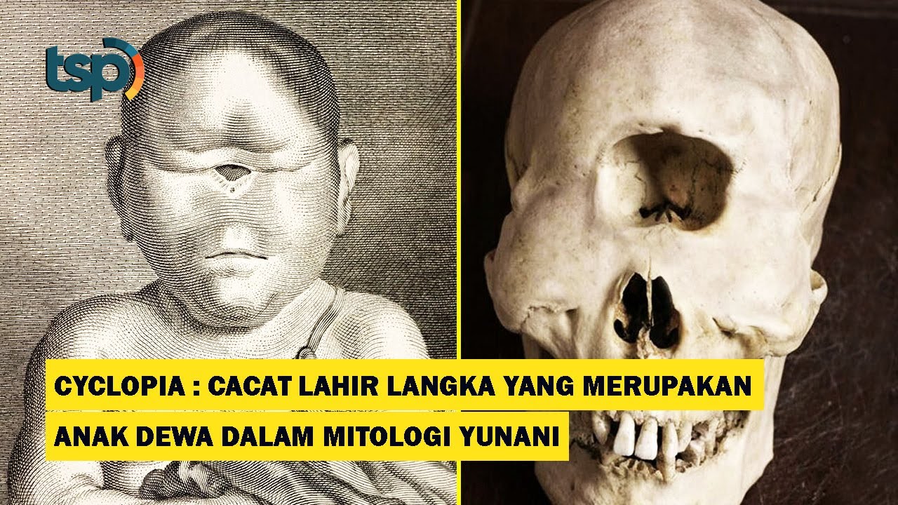 [ENG SUB] Cyclopia, A rare birth defect similar to the Children of Gods in Greek Mythology