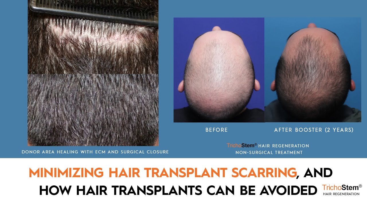 Minimizing Hair Transplant Scars, and Avoiding Scars Altogether with a Non-Surgical Hair Restoration