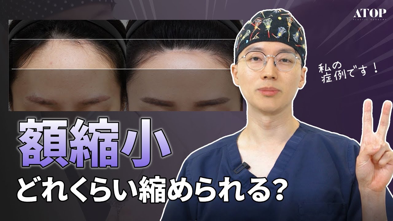 広い額の解決策！額縮小👍👍【エートップ美容整形外科】