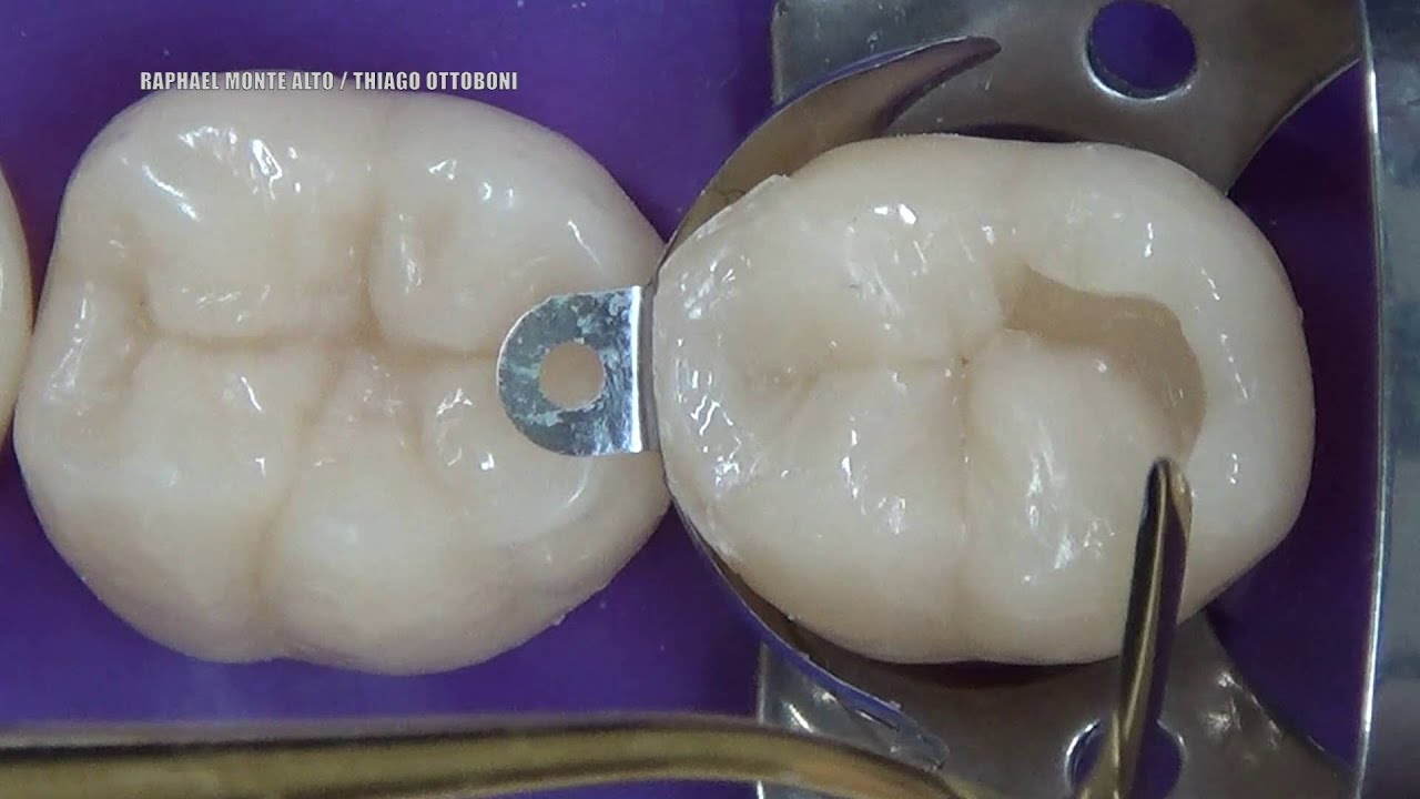 Restauração em resina Classe II - Matriz Palodent V3