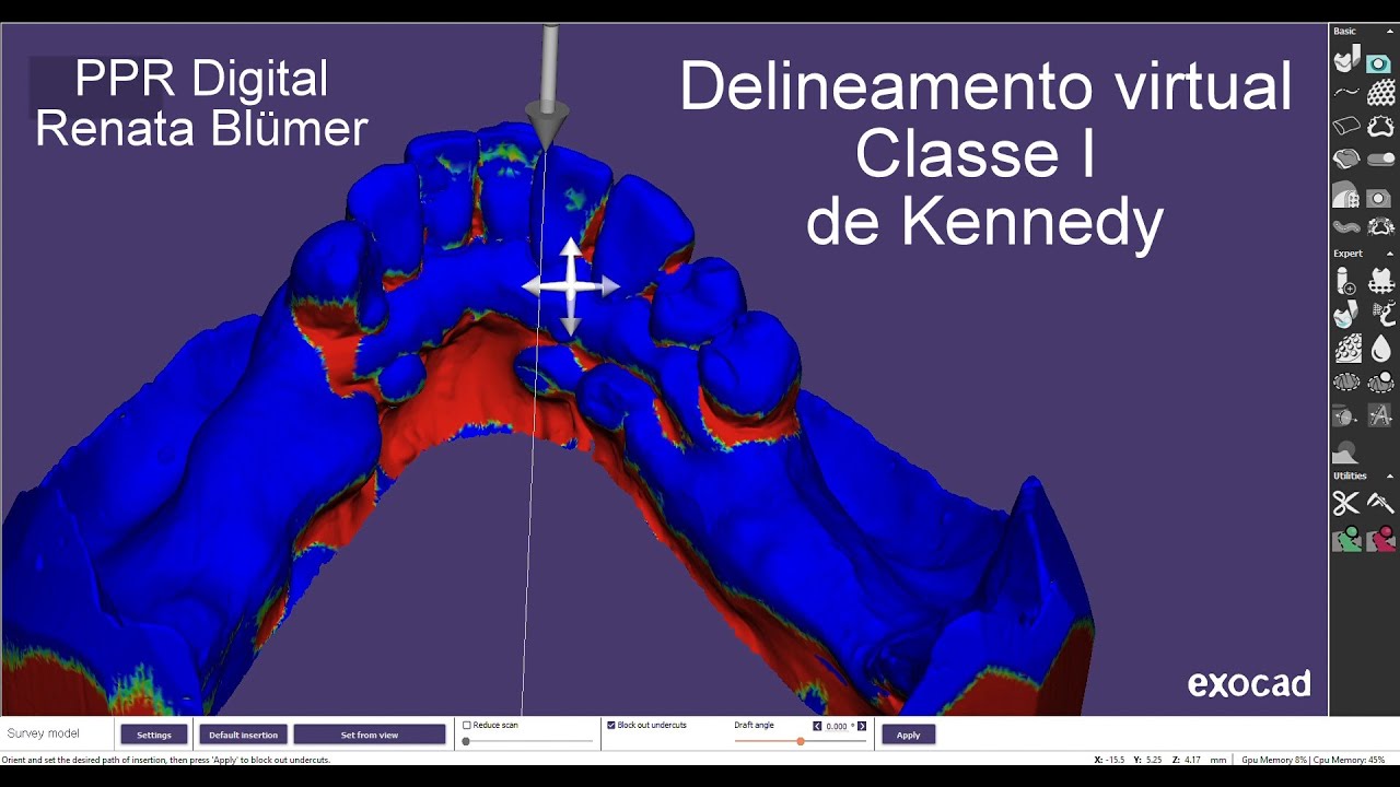 PPR Digital Renata Blümer e Liga de Co-Cr G500 - Delineamento Classe I de Kennedy