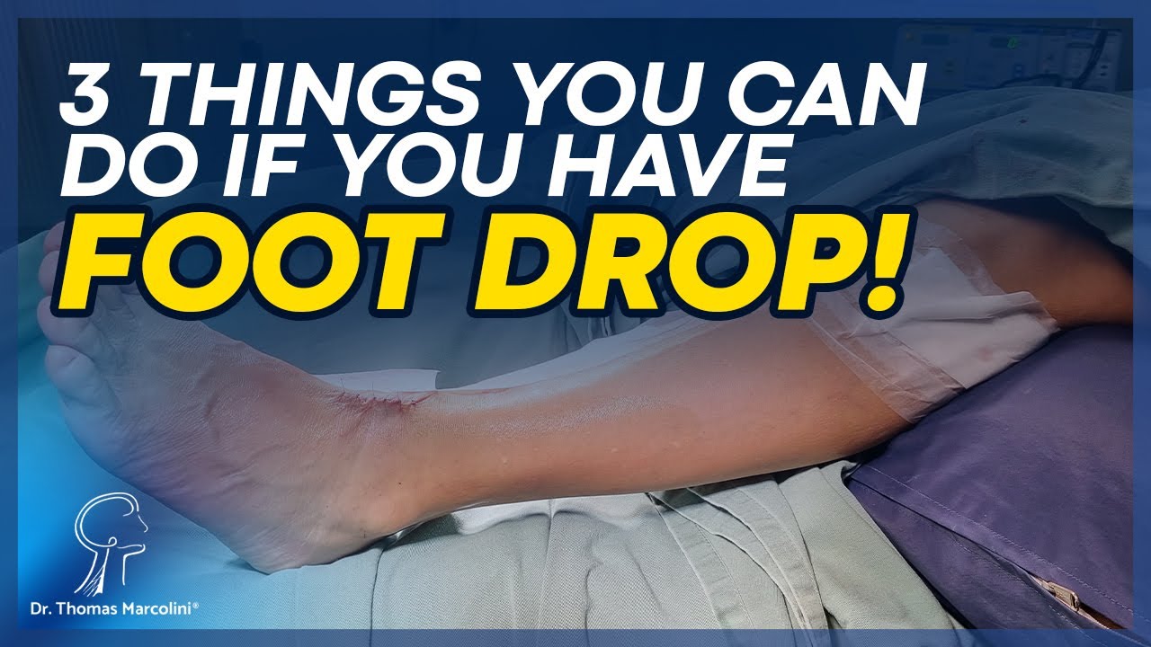 Foot Drop Surgery: When is it Done, What are the Indications? Restoring Foot Mobility!!
