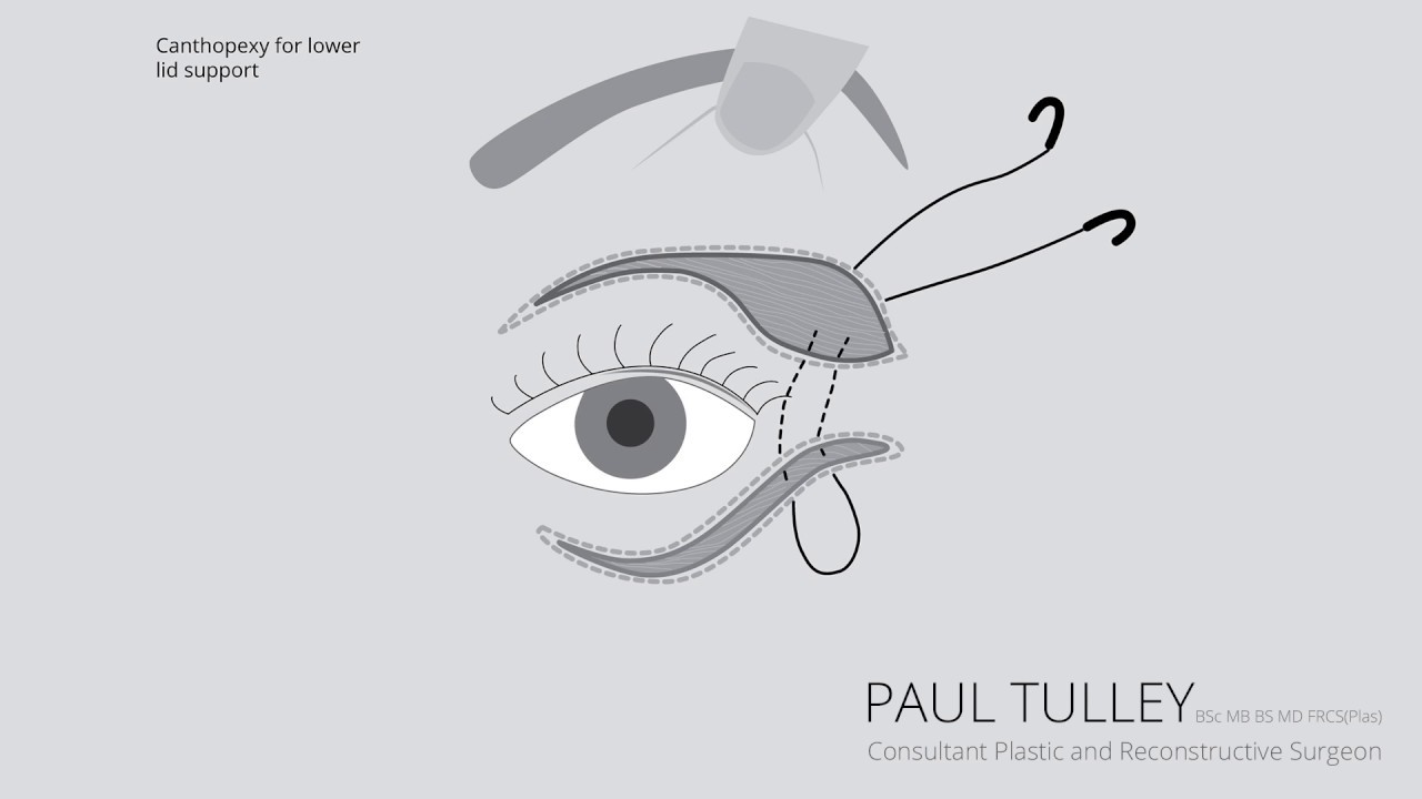 Eyelid Surgery | Eyelid Lift | Mr Paul Tulley