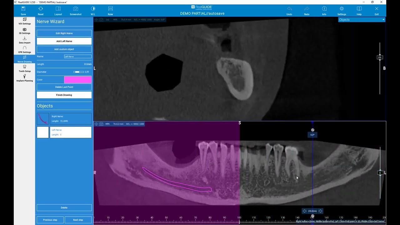RealGUIDE Software: Nerve Drawing