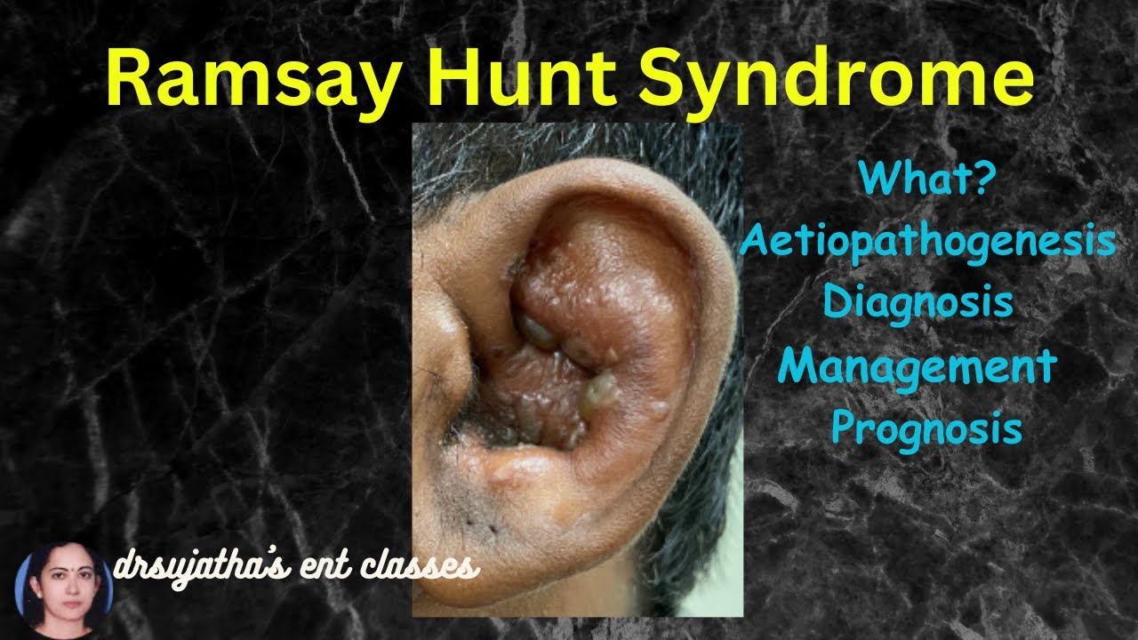 254.Herpes Zoster Oticus / Ramsay Hunt Syndrome #ents