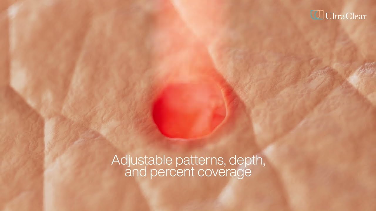 UltraClear&reg; Laser Coring&trade; Animation