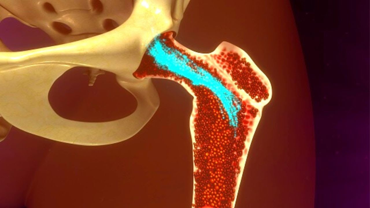 Bone Marrow transplant: How it's used for treating cancer and other neurological disorders