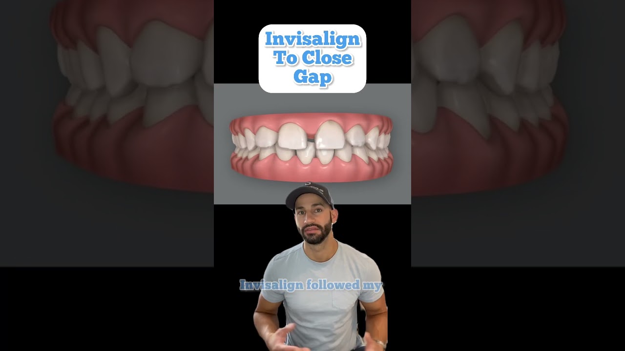 Invisalign case review and modifications to improve before and after result. 2023