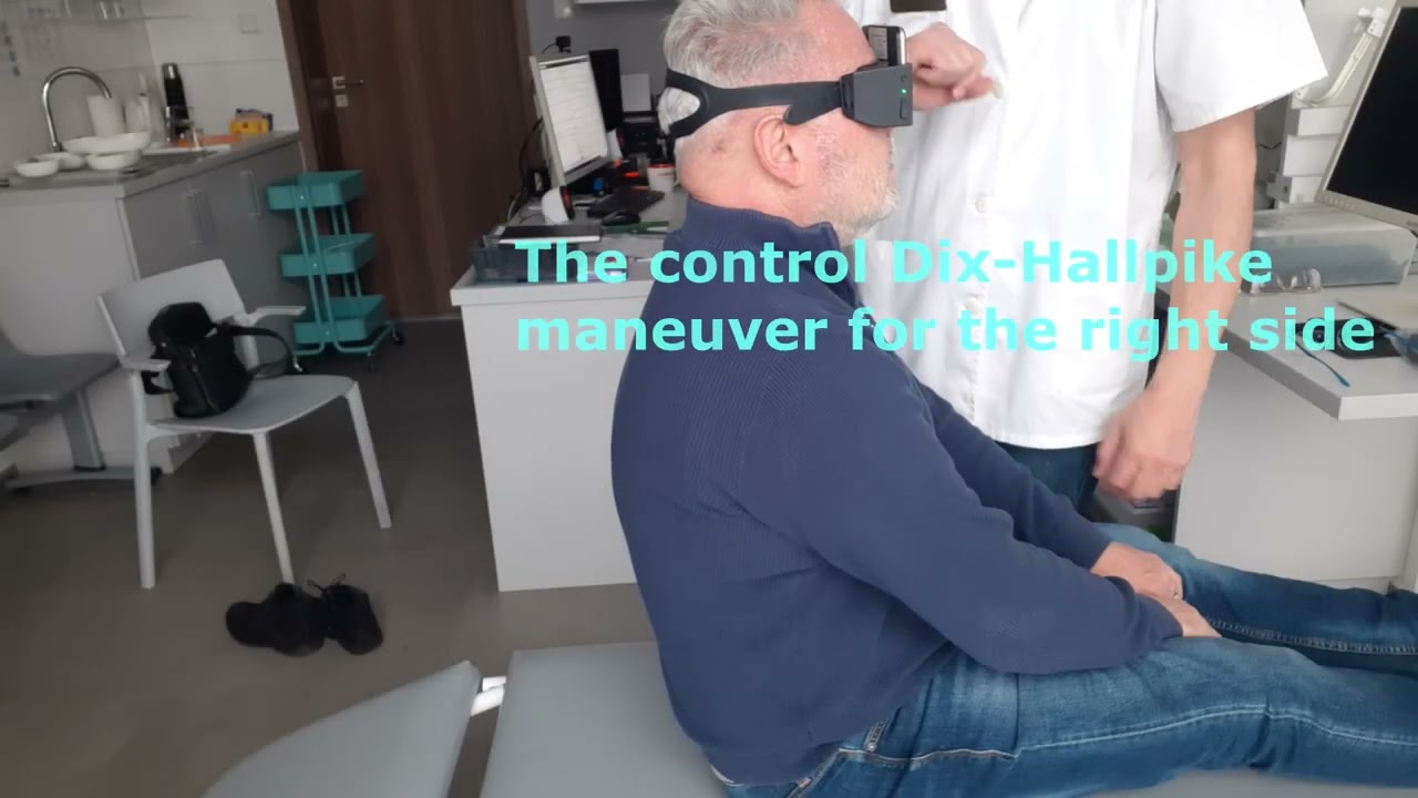The posterior canal canalolithiasis BPPV resolved easily with the Epley maneuver