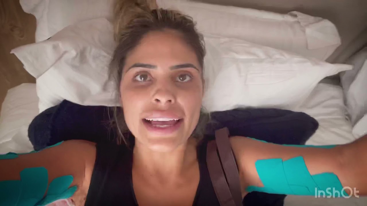 Evolu&ccedil;ao Lipo lad, uma semana de cirurgia. Vem assistir ❤️