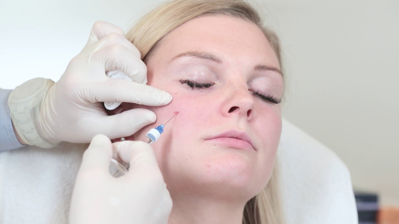 Cheeks with Restylane LYFT