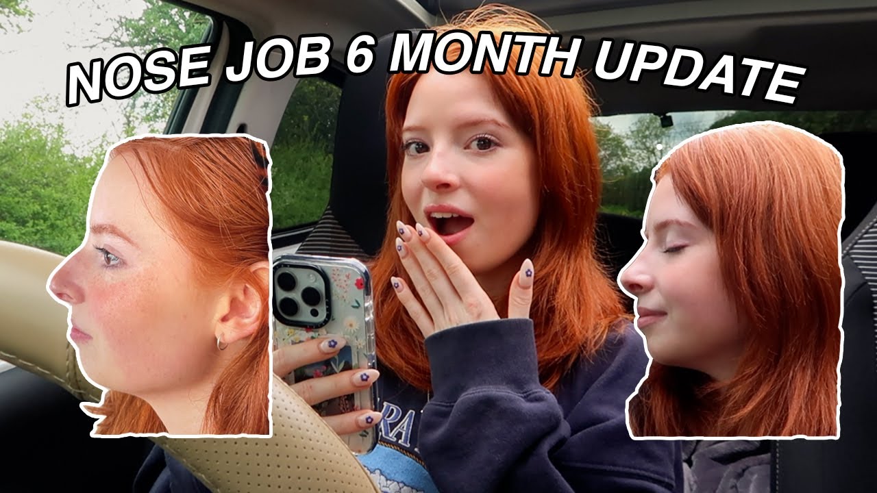 NOSE JOB UPDATE - SIX MONTHS LATER! Any Regrets? Was it Worth It?!