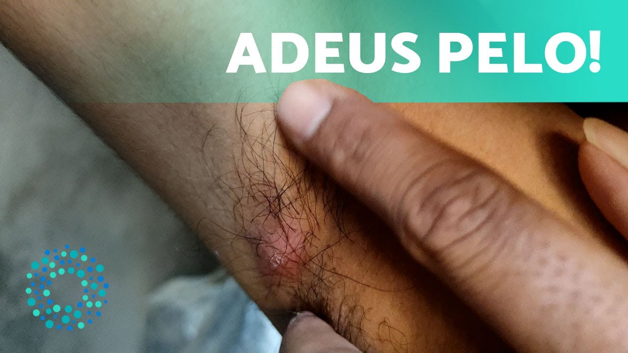 Como REMOVER um PELO ENQUISTADO na AXILA? 🤔 (Pelo encravado na axila)