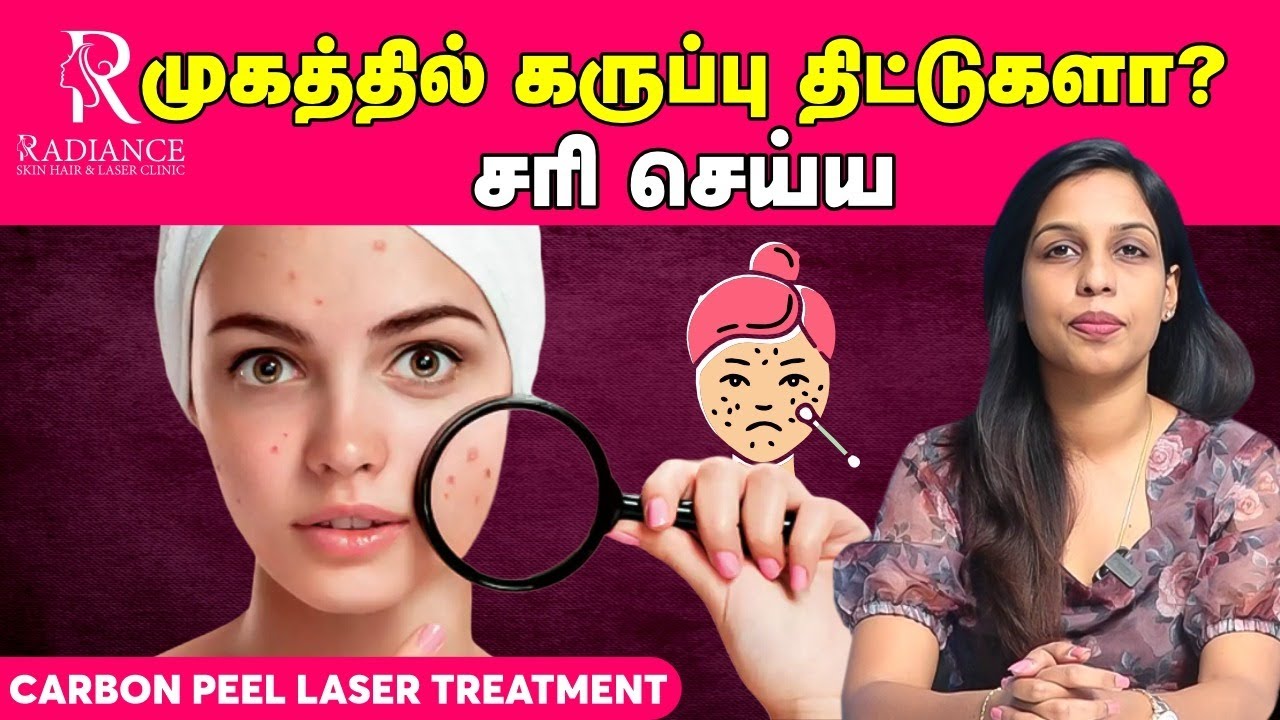 முகத்தில் கருப்பு திட்டுகளா ?  சரி செய்ய  carbon peel laser treatment | Dr. Rakhavi Midhun | Trichy