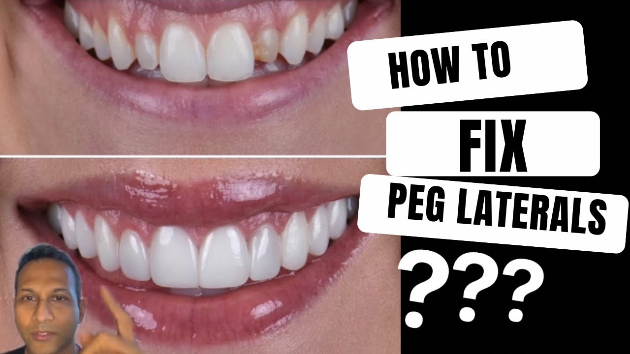 How to fix Peg Laterals - Dr. Patel explains