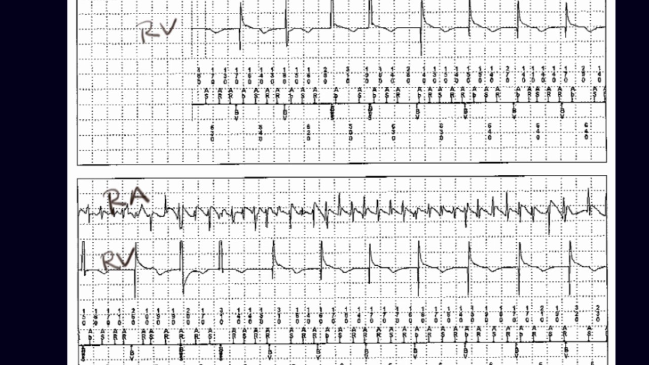Diagnosis of atrial fibrillation during device interrogation using intracardiac electrogram