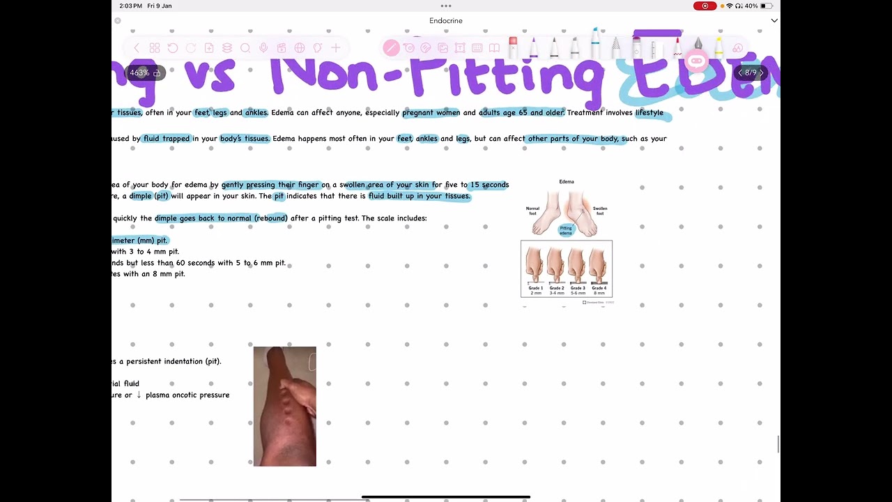 Pitting vs non pitting edema