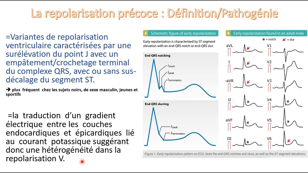 La repolarisation pr&eacute;coce : Ce n'est plus anodin !