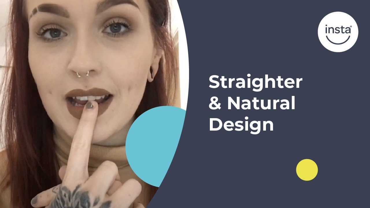 Taylor's Story: Missing/Discoloured Teeth | Instasmile Review