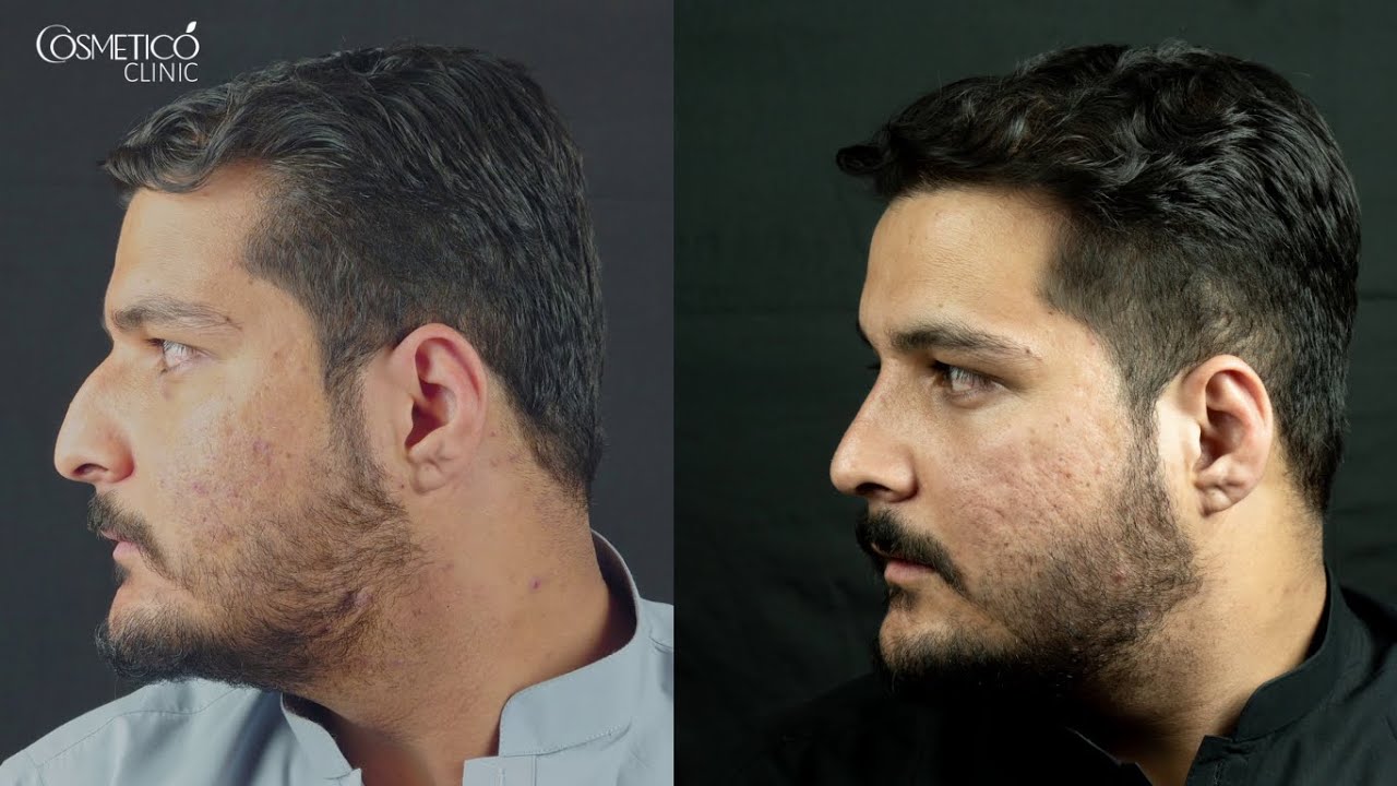Best Results of Rhinoplasty Surgery | Patient Experience | Dr. Kamal
