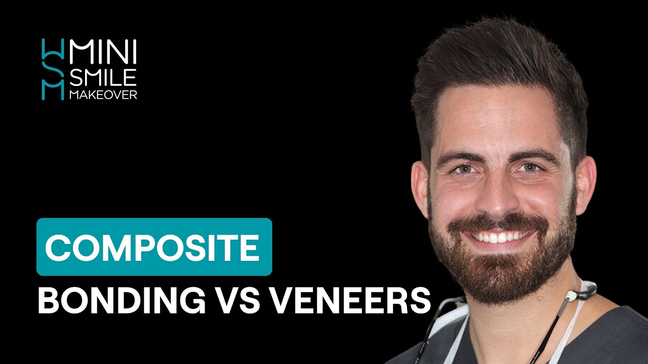 Composite Bonding vs Composite Veneers