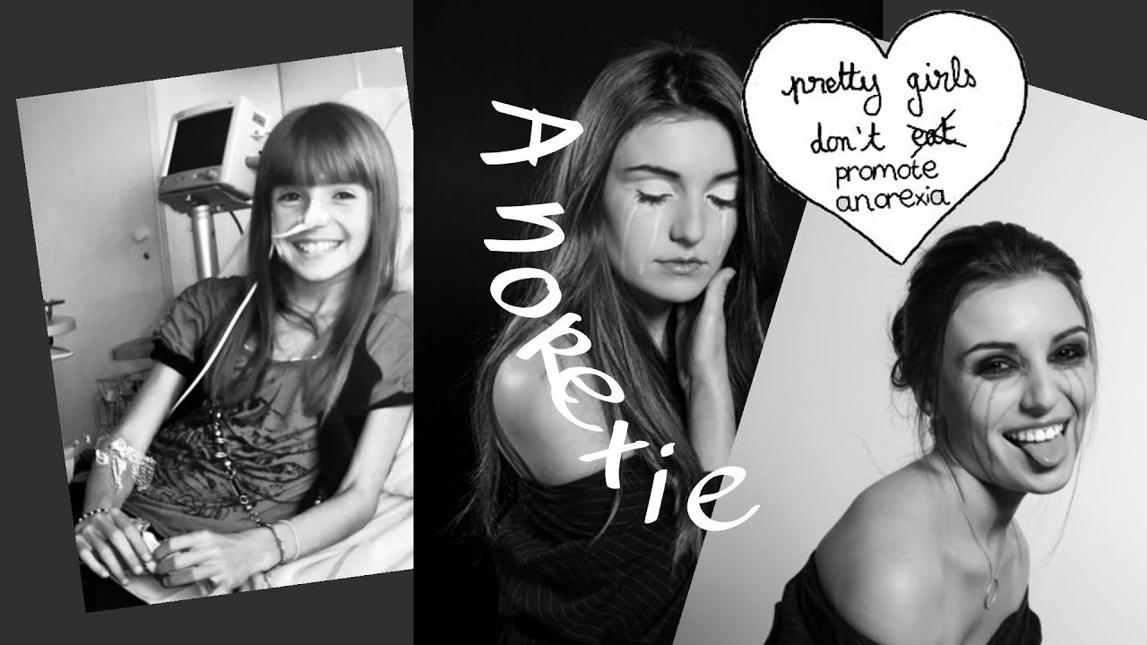 TOUT SUR MA PERIODE D'ANOREXIE