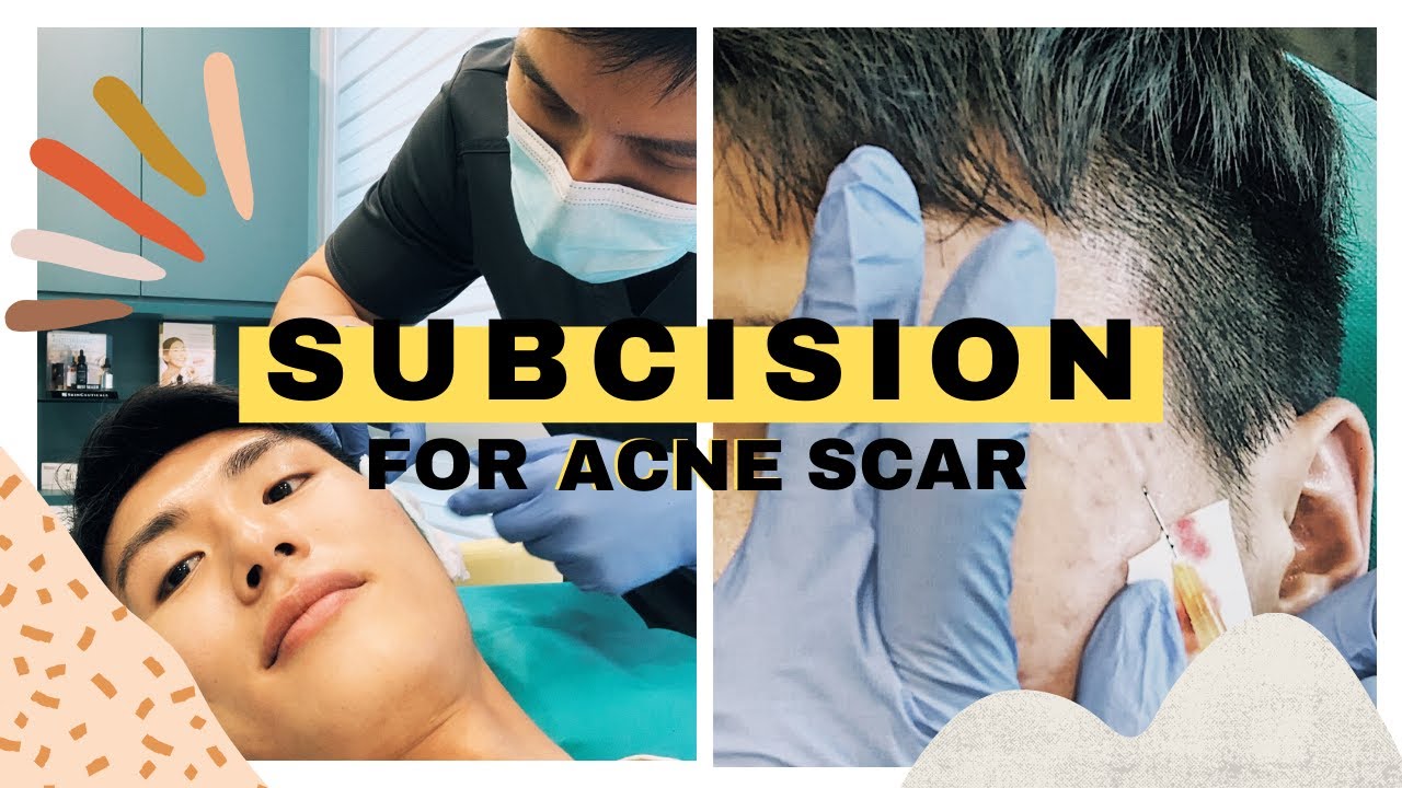 Subcision for Acne Scar | The Most Effective Scar Treatment