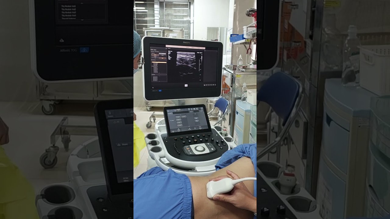 Tê cơ vuông thắt lưng (QL) dưới hướng dẫn siêu âm