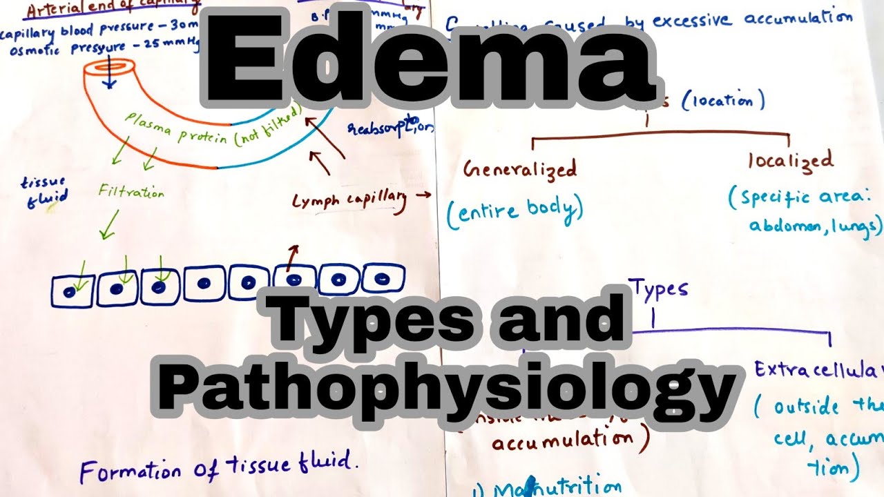 Edema/Oedema | Types and its Pathophysiology