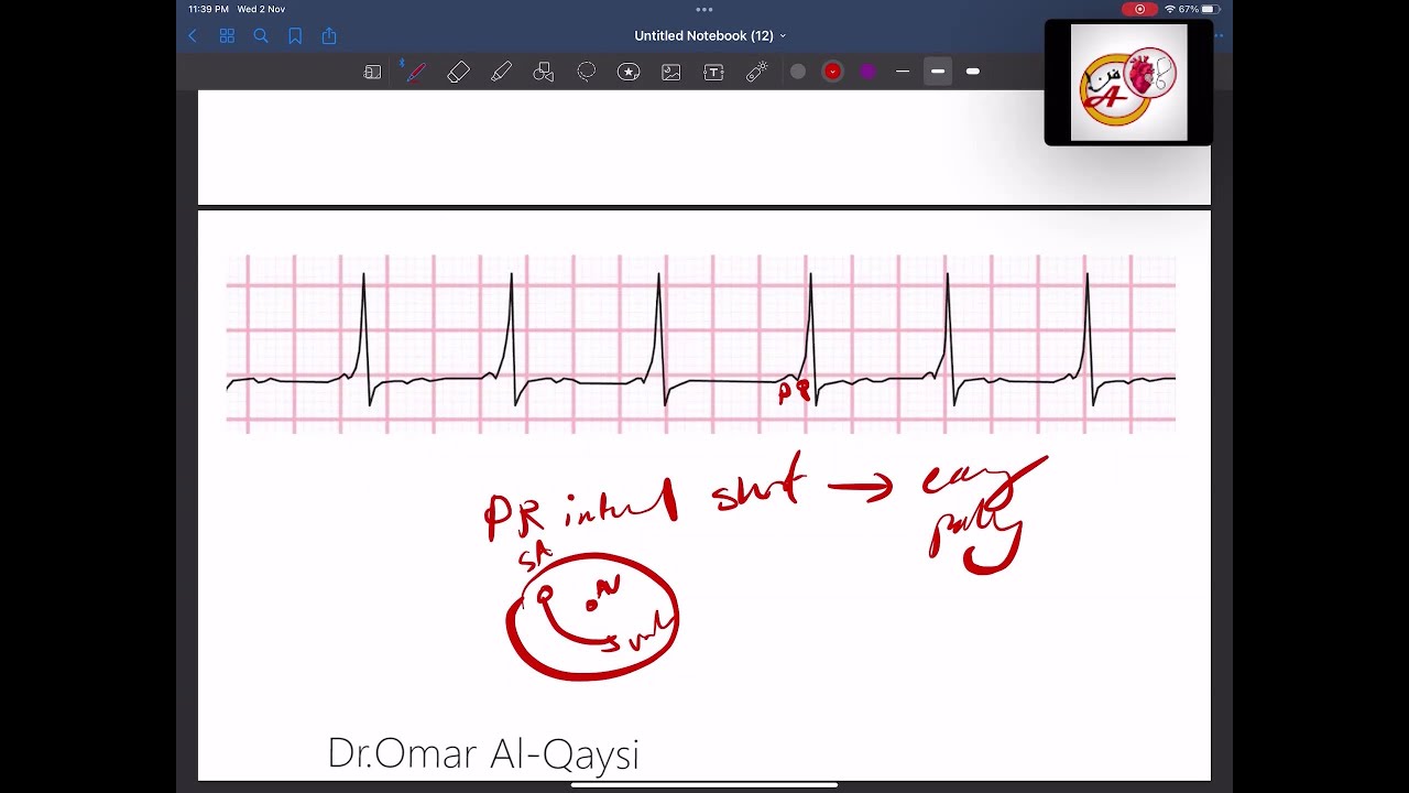 ECG interpretation the basics  │ اساسيات تخطيط القلب