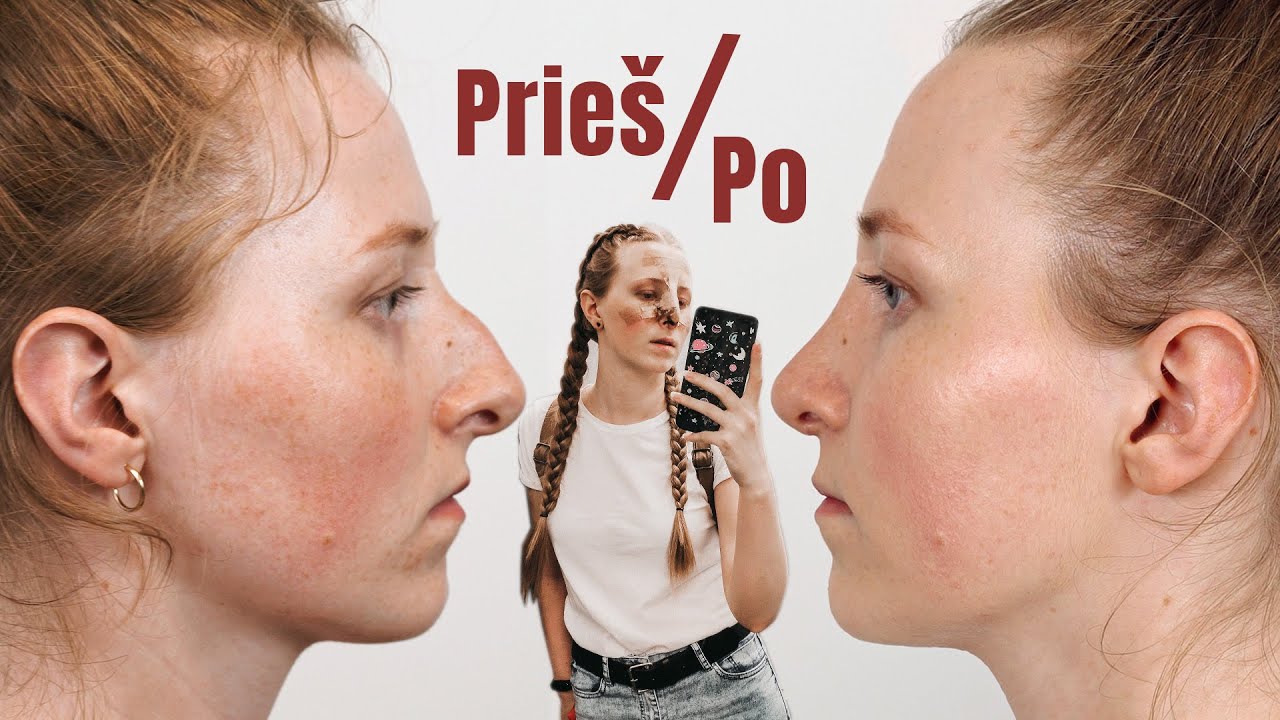 NOSIES GIJIMAS PO OPERACIJOS  - mano patirtis