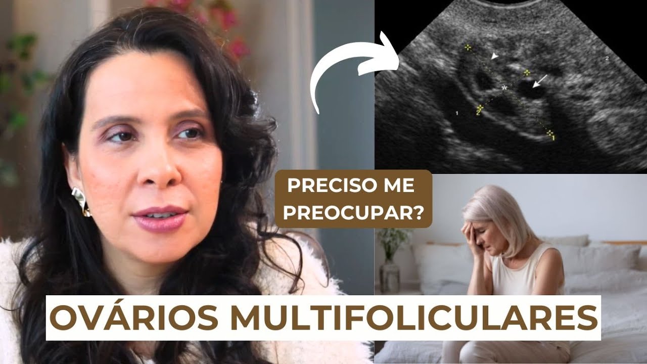Ovários Multifoliculares: Sintomas, Diagnóstico e Tratamento
