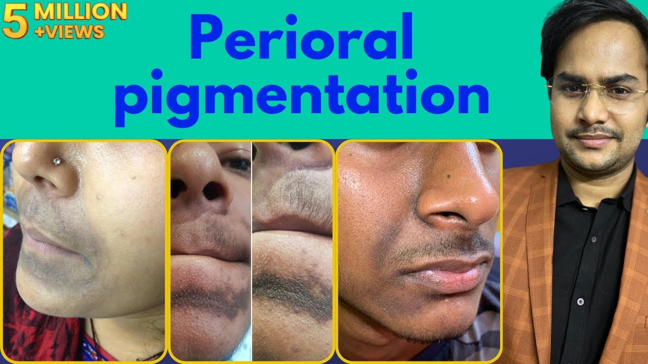 होठों के आसपास का कालापन कैसे दूर करें| How To Remove Black Spots Around Mouth and Nose/ Dr Uttam