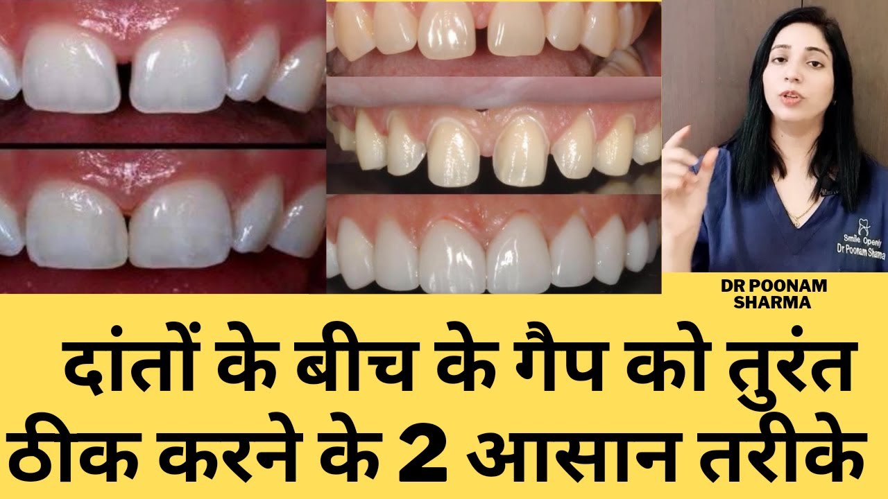 बिना ब्रेसेस दांतो के बीच के गैप को भरने के तरीके। Treatment Of Midline Diastema |